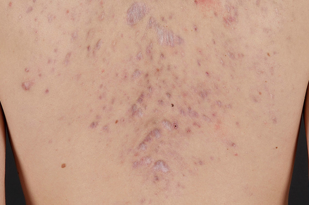 Atrofische littkens na acne