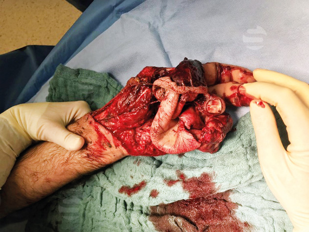 Crush letsel hand