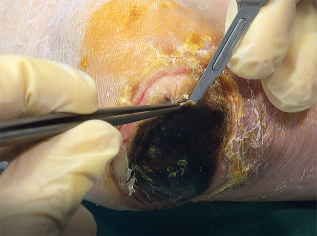 Debridement1 startwondverzorging