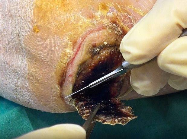 Debridement2 startwondverzorging