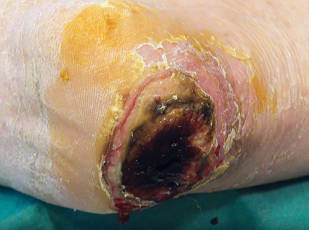 Debridement3 startwondverzorging