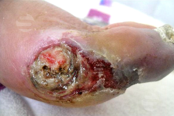 Diabetische voet2