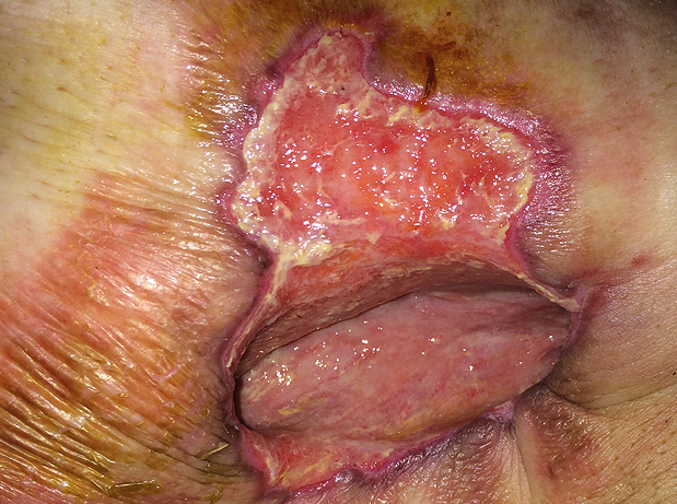 Infectie Decubitus