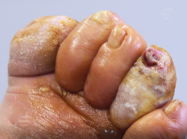 Infectie Diabetische voet