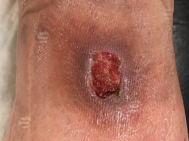Infectie Ulcus cruris