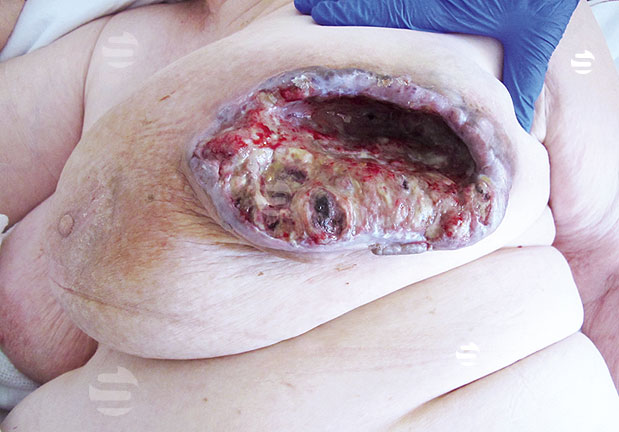 Oncologische wond