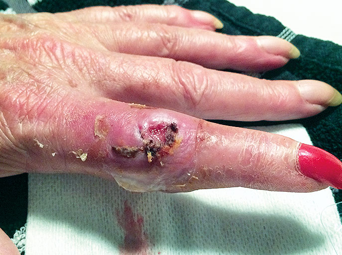 Osteomyelitis na kattenbeet 1