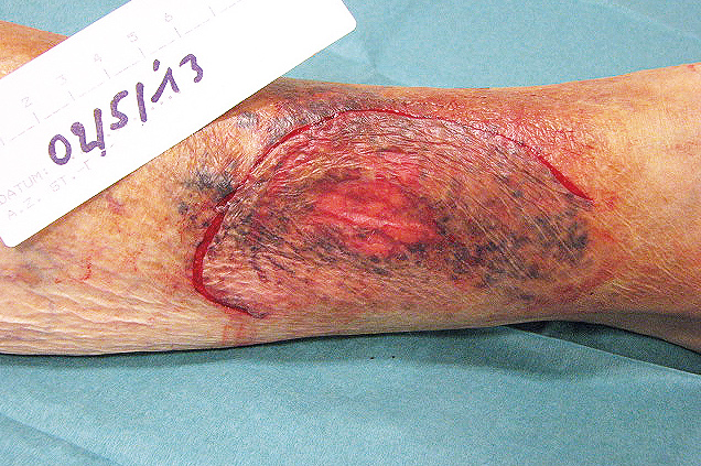 Skin tear geen weefselverlies