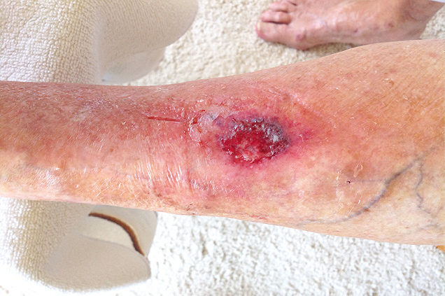 Skin tear volledig weefselverlies