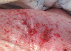 WL Vasculitis