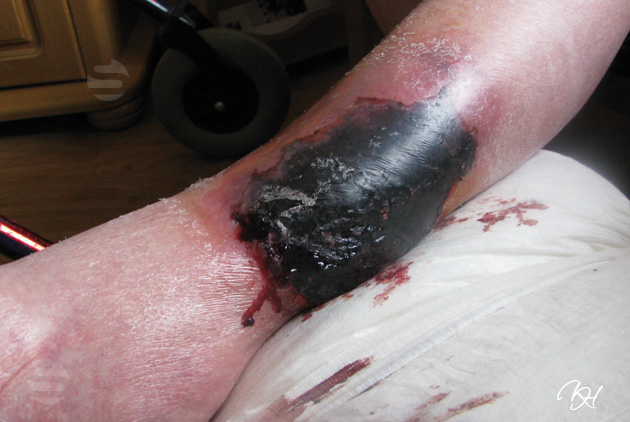 images/p_hematoom.jpg