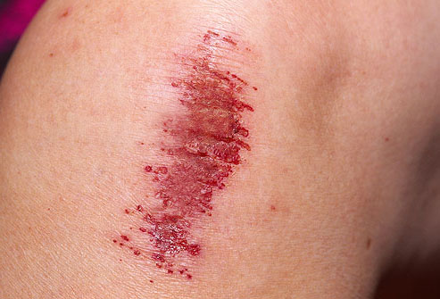 schaafwond aan de knie